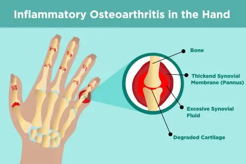 Osteoarthritis punca sakit jari tangan