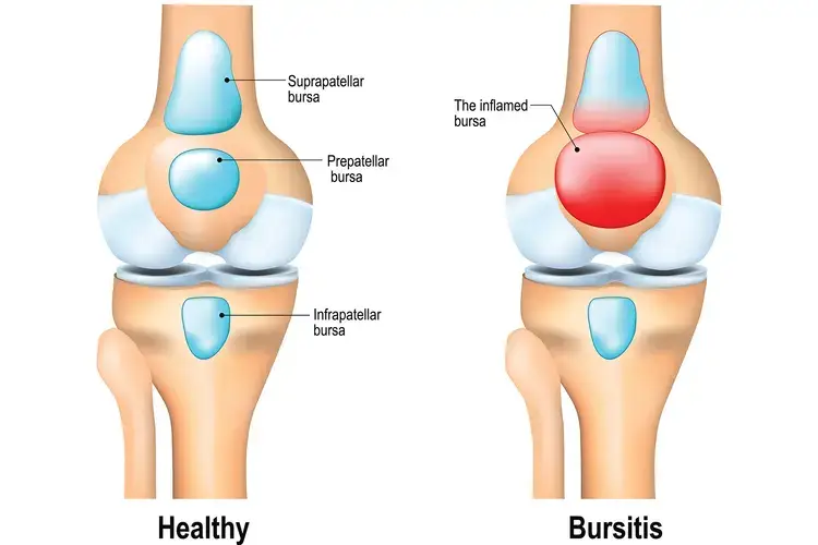 bursitis lutut yang menyebabkan sakit lutut kiri