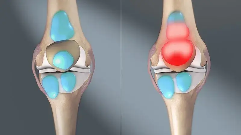 bursitis punca sakit lutut tiba-tiba