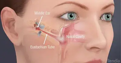 Eustachian Tiub Tersumbat punca telinga tersumbat Sebab Selsema -Klinik Tuah