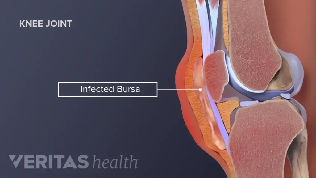 bursitis punca air lutut terhasil