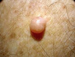 neurofibroma juga membentuk benjolan di badan