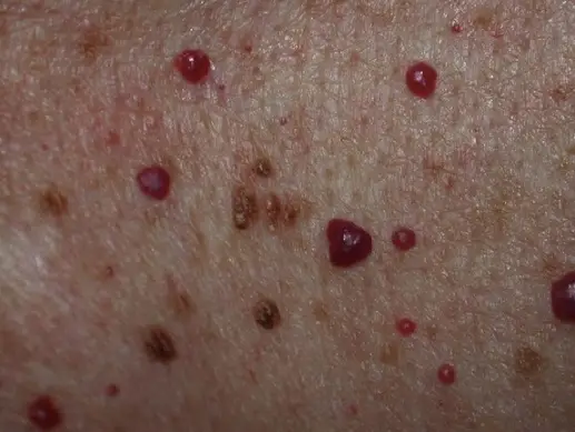 gambaran cherry angioma membentuk benjolan di badan