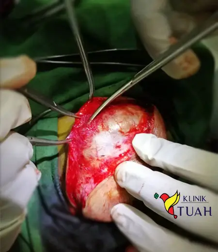 pembedahan membuang benjolan di badan akibat lipoma