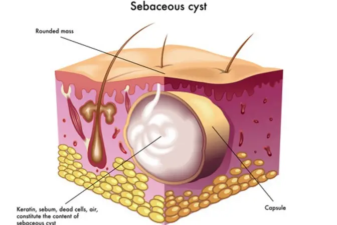 gambaran bagaimana cyst membentuk benjolan di badan