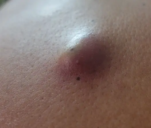 gambaran benjolan di badan akibat cyst
