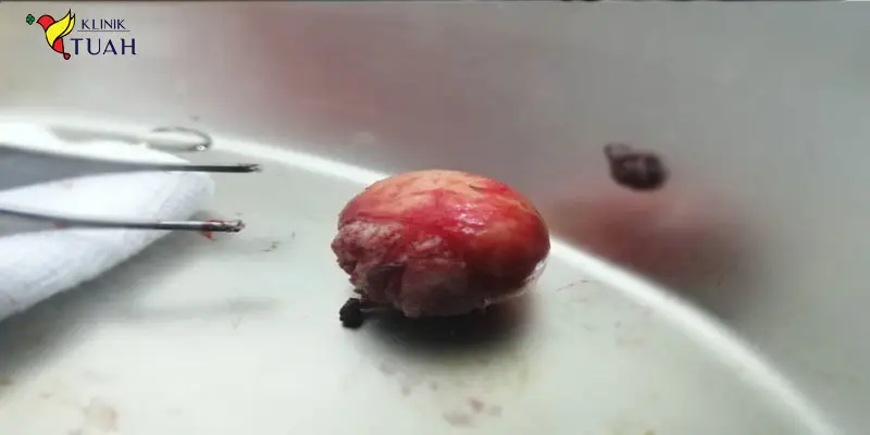benjolan di badan akibat cyst