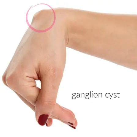 gambaran ganglion cyst membentuk benjolan di tangan