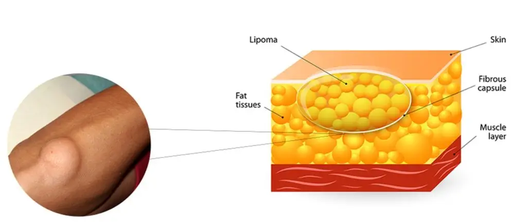 bagaimana lipoma membentuk benjolan di badan