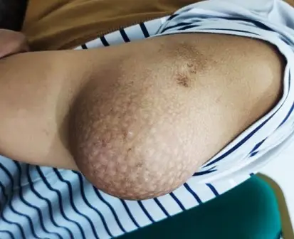 lipoma menyebabkan benjolan di badan