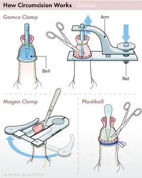 type of clamp circumcision which are gomco, mogen and plastibell