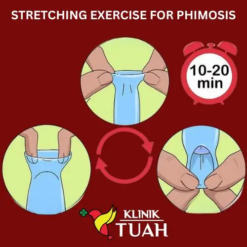 foreskin stretching tips to fix phimosis