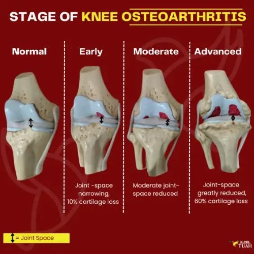 stage of osteoarthritis under article glucosamine for knee pain