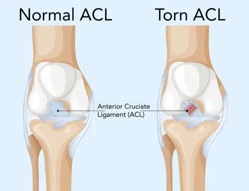 jenis sakit lutut disebabkan koyakan ACL