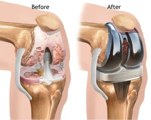Rawatan jenis sakit lutut osteoarthritis tahap akhir ialah pembedahan tukar lutut