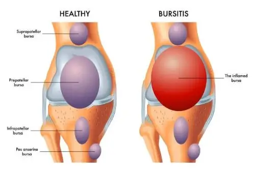 jenis sakit lutut bursitis