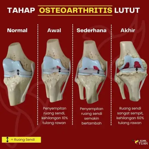 tahap osteoarthritis dalam artikel jenis sakit lutut