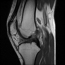 imej MRI kecederan ACL