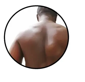 gambaran menunjukan ketulan lipoma di badan