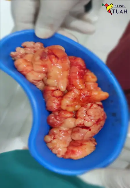 ketulan ketulan lipoma selepas dibuang