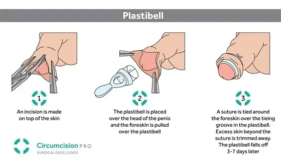 kaedah plastibell untuk khatan anak lelaki sewaktu bayi