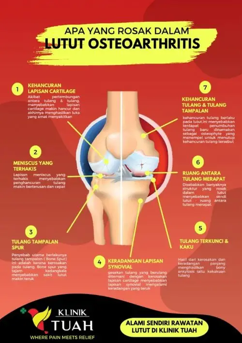 tanda osteoarthritis di bawah artikel klinik pakar sakit lutut Shah Alam
