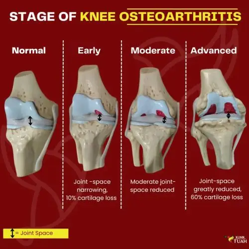 stage of osteoarthritis under knee effusion