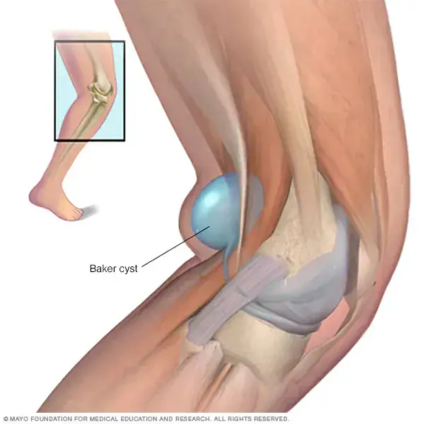baker cyst cause knee effusion
