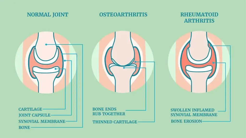 knee pain caused by rheumatoid arthritis and osteoarthritis