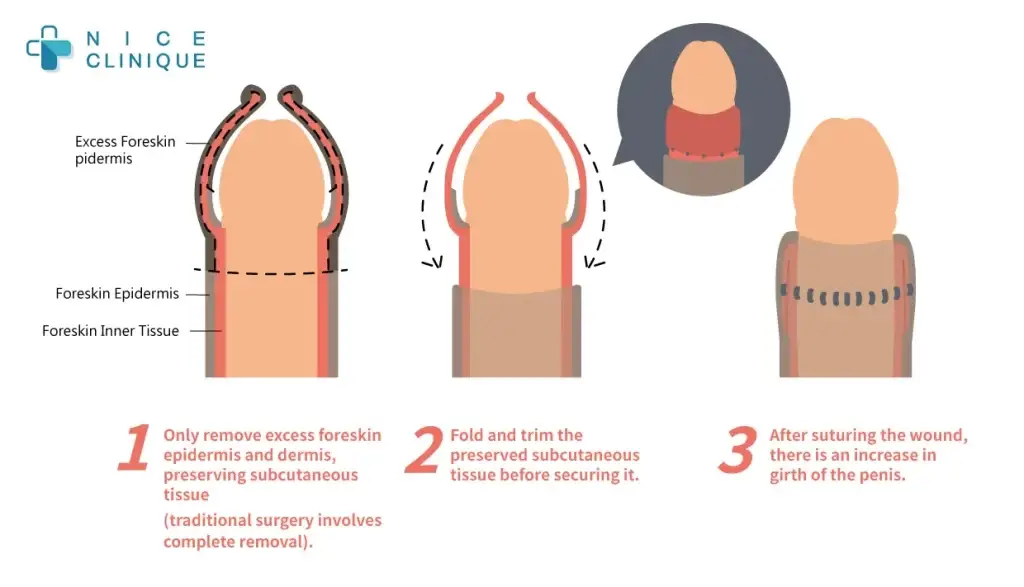 laser circumcision procedure