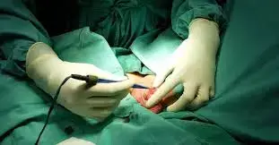 laser circumcision knows for its precision and safety
