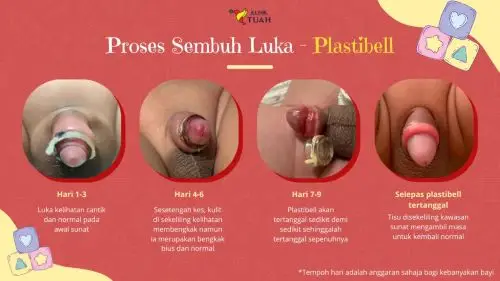 fasa penyembuhan luka sunat plastibell di bawah artikel tanda luka sunat lambat sembuh