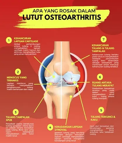 inforgrafik tentang osteoarthritis antara punca lutut bengkak