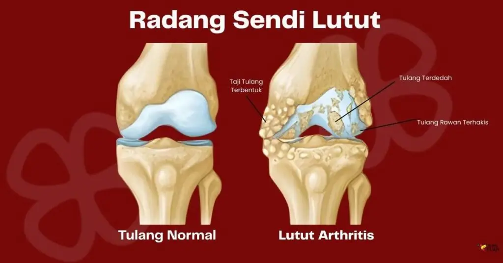 tulang rawan cedera punca lutut berbunyi