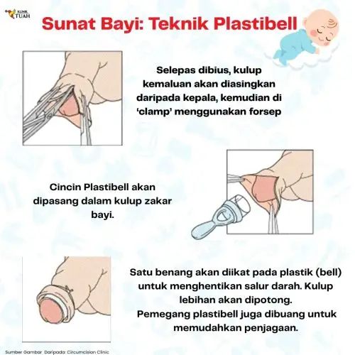 prosedur plastibell di bawah artikel penjagaan selepas sunat plastibell klinik tuah