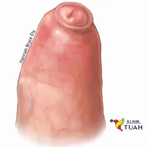 picture of phimosis in which prepuce cannot be retracted