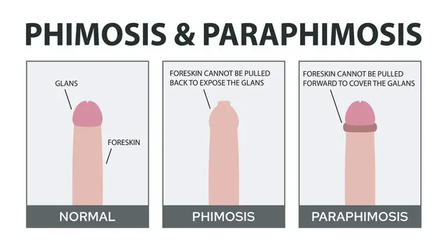 phimosis and paraphimosis differences
