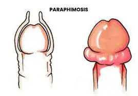 paraphimosis picture in phimosis vs paraphimosis