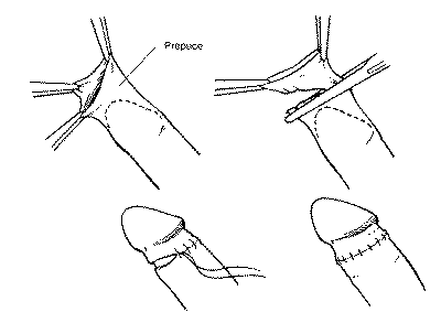 kaedah sunat plastibell vs laser