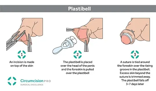 kaedah sunat plastibell vs laser