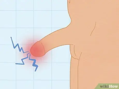 swelling penis is normal during post circumcision care