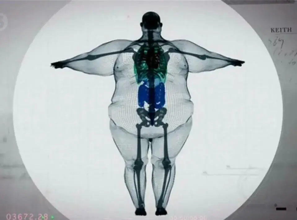 gambaran xray obesiti di bawah artikel rawatan sakit lutut