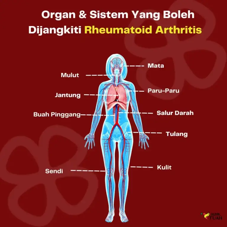 organ yang terjejas akibat rheumatoid arthritis