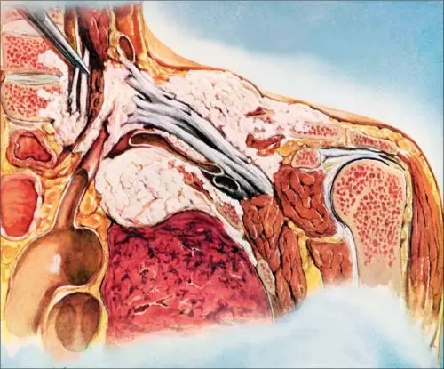 sakit bahu disebabkan kan tumor Pancoast