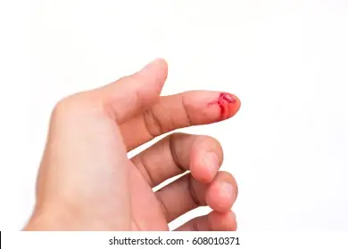 kecederaan punca sakit jari tangan