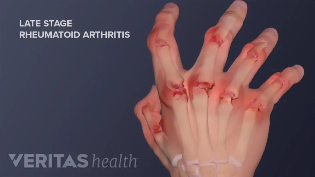 Rheumatoid arthritis punca sakit jari tangan