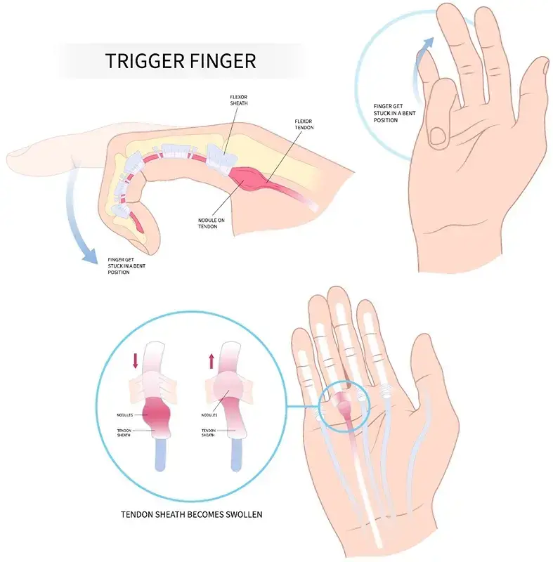 Trigger finger punca sakit jari tangan