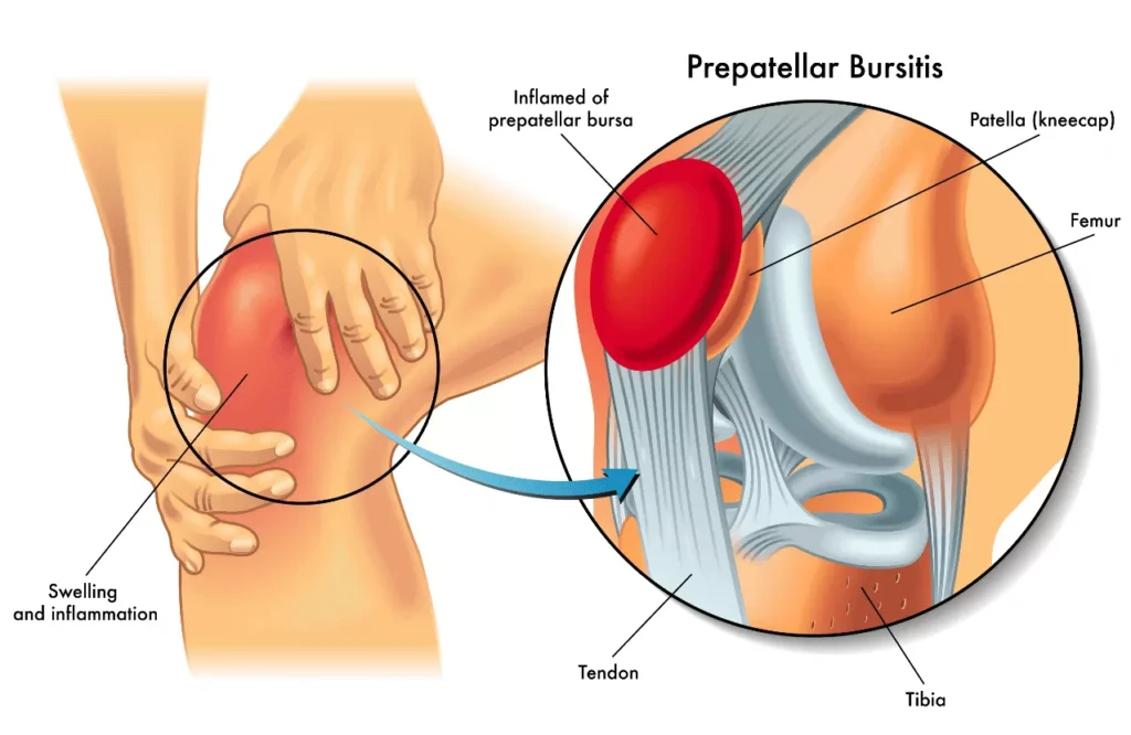 bursitis yang menyebabkan sakit lutut