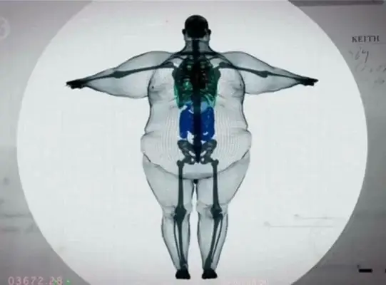 x ray pesakit obesiti yang punca sakit lutut di usia muda