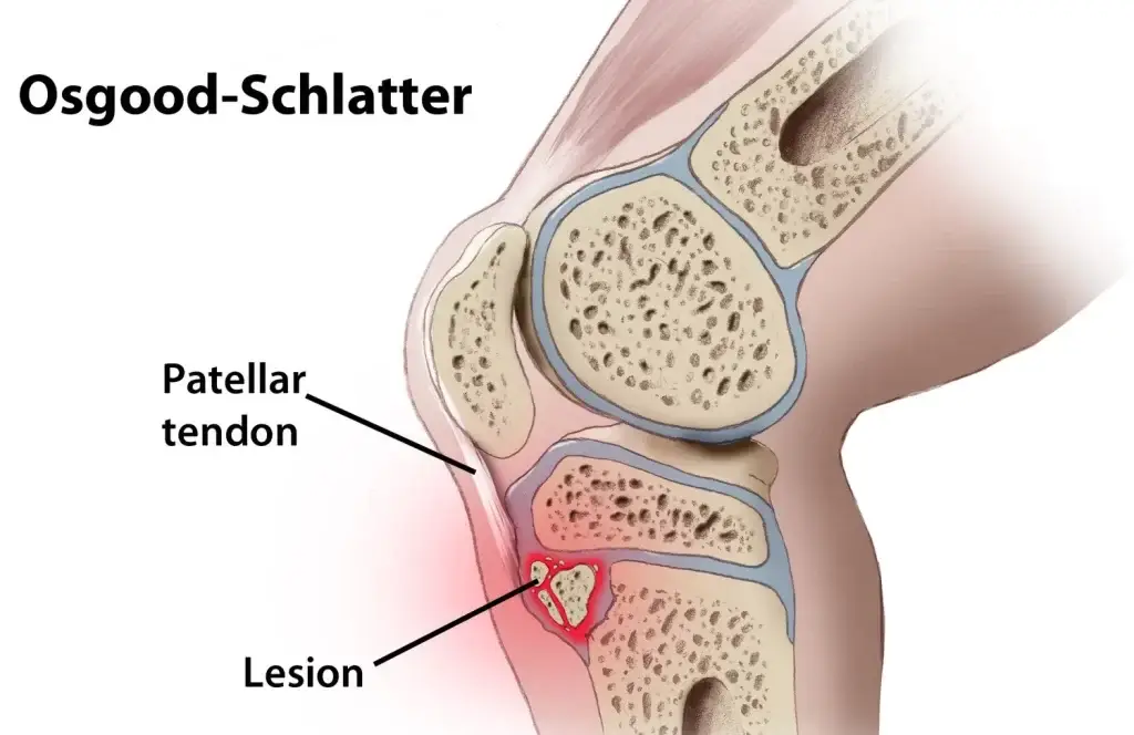 penyakit osgood-schlatter menjadi punca sakit lutut di usia muda